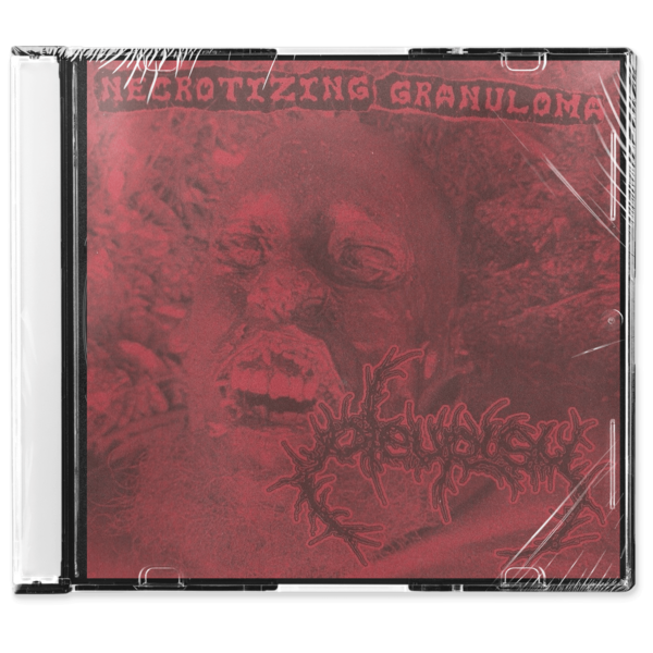 Pleurisy 'Necrotizing Granuloma' CD